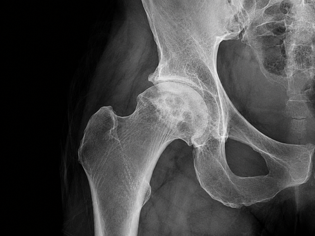 X-ray showing avascular necrosis of the hip — treated by Dr. Sandeep Gupta