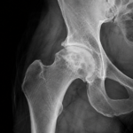 Avascular Necrosis of the Hip: Why Early Diagnosis Changes Everything